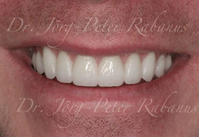 Porcelain Veneers With Typical Aesthetic Characteristics 