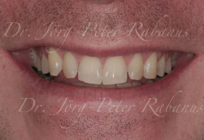 Porcelain Veneers Without Typical Aesthetic Characteristics 