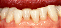 misaligned teeth in cosmetic dentistry