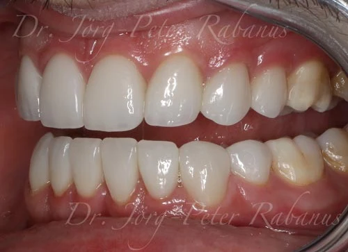 smile makeover after replacement of porcelain veneers and gum lift