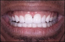after cosmetic dental procedure