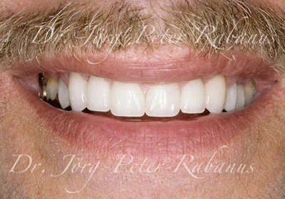 Aged teeth after cosmetic dentistry