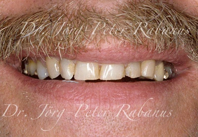 Aged teeth before cosmetic dentistry