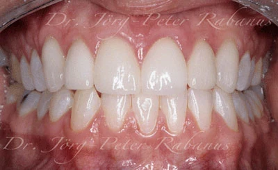 Stained and misaligned teeth before treatment with cosmetic dentistry