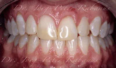 Stained and misaligned teeth after treatment with cosmetic dentistry