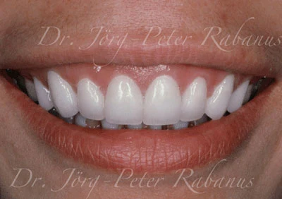 Stained teeth after placement of porcelain laminates