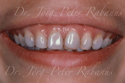 Stained teeth without porcelain laminates