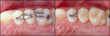 beautiful back teeth in cosmetic dentistry