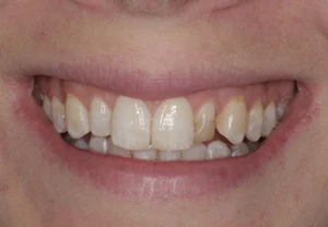 conservative-cosmetic-dentistry-with-bleaching-and-porcelain-veneers-before