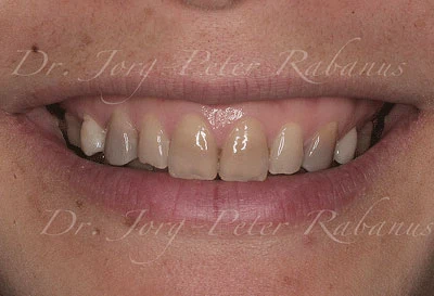 Tetracycline-stained Teeth without Porcelain Veneers