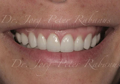 Tetracycline-stained Teeth with Porcelain Veneers