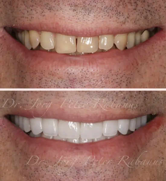 durable veneers placed by best cosmetic dentist san francisco porcelain veneers placed by expert cosmetic dentist