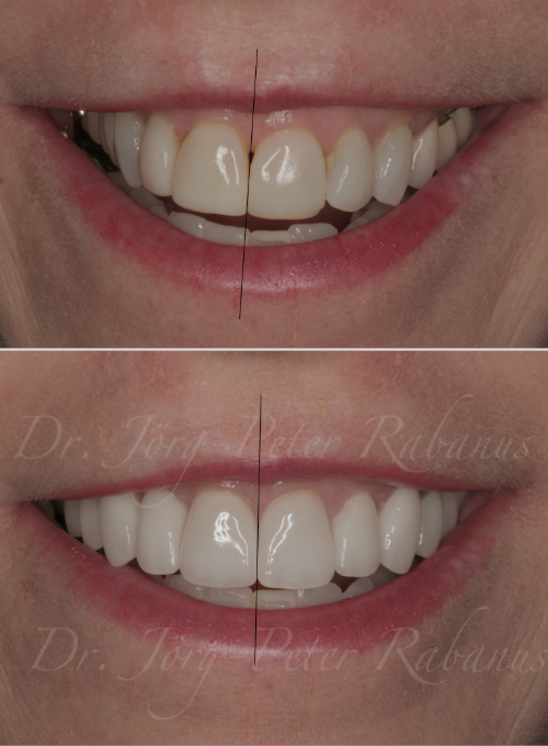 Canted Smile San Francisco Treated With Porcelain Veneers and Nivellation Of Gum Line Canted Smile San Francisco
