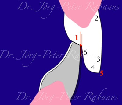 Smile Design Starts With Central Incisor