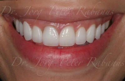 natural veneers san francisco completed