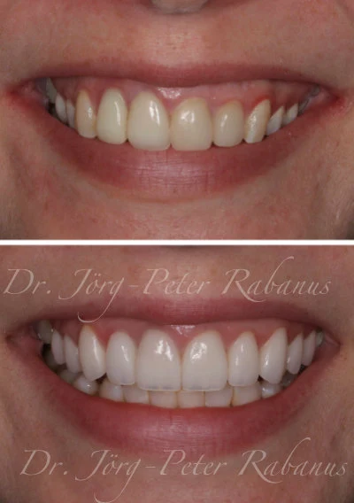 natural veneers in San Francisco by AACD-accredited cosmetic dentist natural veneers san francisco