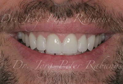 New Porcelain Veneers Placed By Cosmetic Dentist Porcelain Veneers With Vital Aesthetic Characteristics
