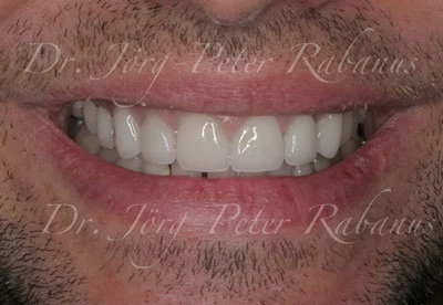Porcelain Veneers Prior to Replacement Porcelain Veneers Missing Vital Aesthetic Characteristics