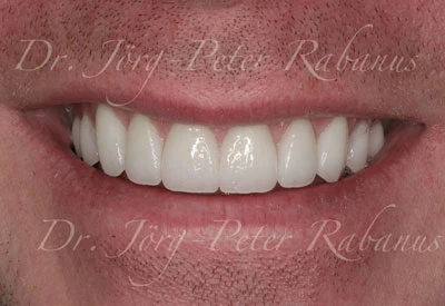 Typical Aesthetic Characteristics After Replacement of Old Porcelain Veneers Porcelain Veneers With Typical Aesthetic Characteristics
