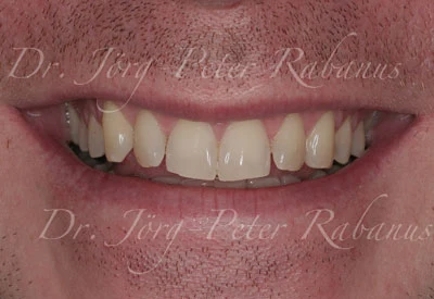 Porcelain Veneers Without Typical Aesthetic Characteristics Before Replacement Porcelain Veneers Without Typical Aesthetic Characteristics