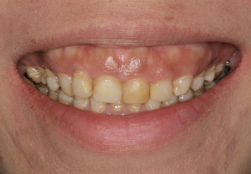 Porcelain Veneers for Stained Teeth with Gummy Smile porcelain veneers san francisco stained teeth gummy smile