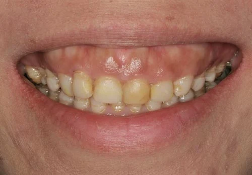 porcelain veneers san francisco stained teeth gummy smile