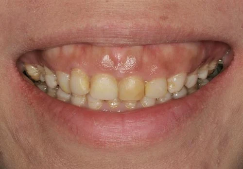 Porcelain Veneers for Stained Teeth with Gummy Smile porcelain veneers san francisco stained teeth gummy smile