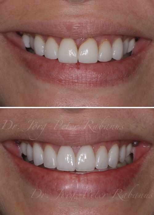 porcelain veneers san francisco before and after