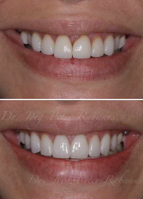 Porcelain Veneers in San Francisco Before-and-After porcelain veneers san francisco before and after