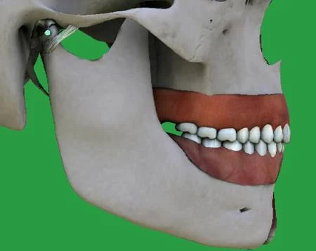 San-Francisco-California-Dental-Implants-&-Porcelain-Veneers-2