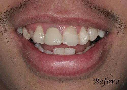 San-Francisco-California-Family-Teeth-Bleaching-Dentistry-1