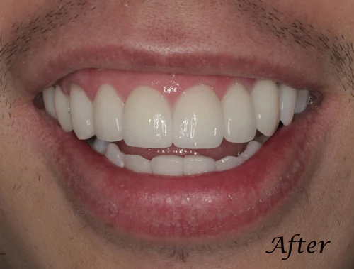 San-Francisco-California-Family-Teeth-Bleaching-Dentistry-2