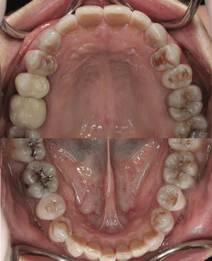 Tetracycline-Associated Dental Hypoplasia-2