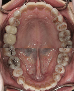 Dental Hypoplasia caused by Tetracycline-2 Tetracycline-Associated Dental Hypoplasia-2