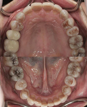 Dental Hypoplasia caused by Tetracycline-2 Tetracycline-Associated Dental Hypoplasia-2