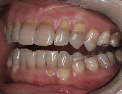Tetracycline-Associated Dental Hypoplasia-1