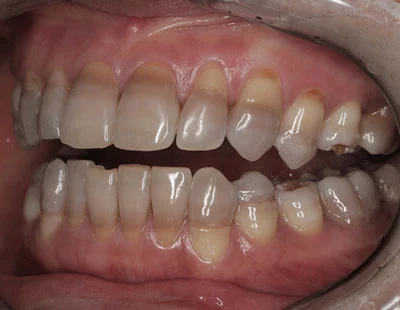 Tetracycline-Associated Dental Hypoplasia-1 Tetracycline-Associated Dental Hypoplasia-1