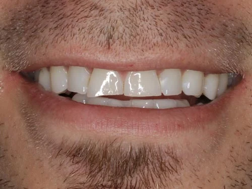 Worn Teeth worn teeth