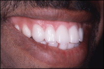 dental gaps after treatment by cosmetic dentist