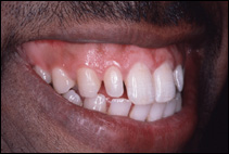 dental gaps before treatment by cosmetic dentist