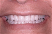 chipped teeth repaired with veneers