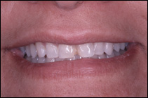 chipped teeth