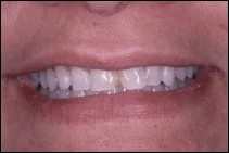 chipped teeth