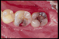 dental bonding procedure