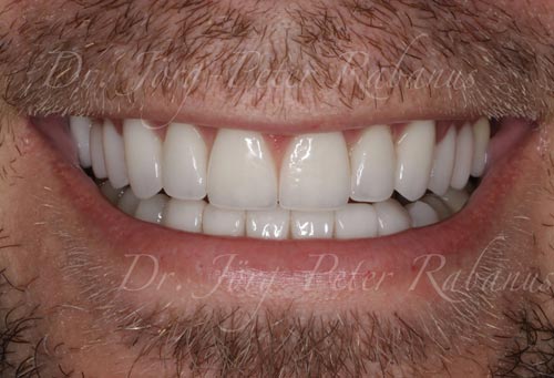 Porcelain Veneers For You best porcelain veneers sf