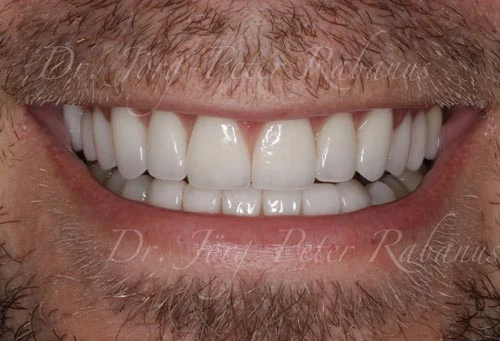 best porcelain veneers sf