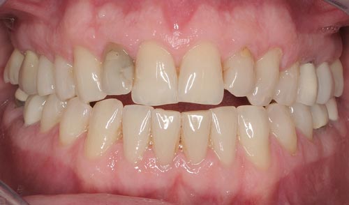 porcelain veneers san francisco are best natural 3 best porcelain veneers san francisco are natural 3