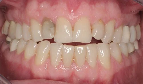 best porcelain veneers san francisco are natural 3