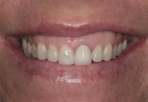best porcelain veneers best porcelain veneers cosmetic dentist san francisco