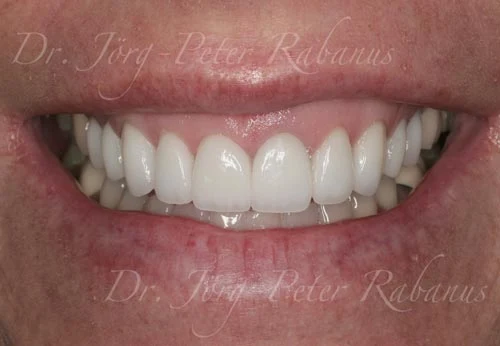 porcelain veneers cosmetic dentist in san francisco